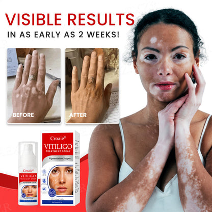 [Official Store]:Croaie® Vitiligo Treatment Spray- Natural Skin Tone Restoration